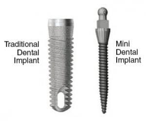 mini implant vs dental implant