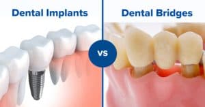Dental Implant vs. Bridge