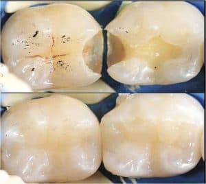 tooth filling