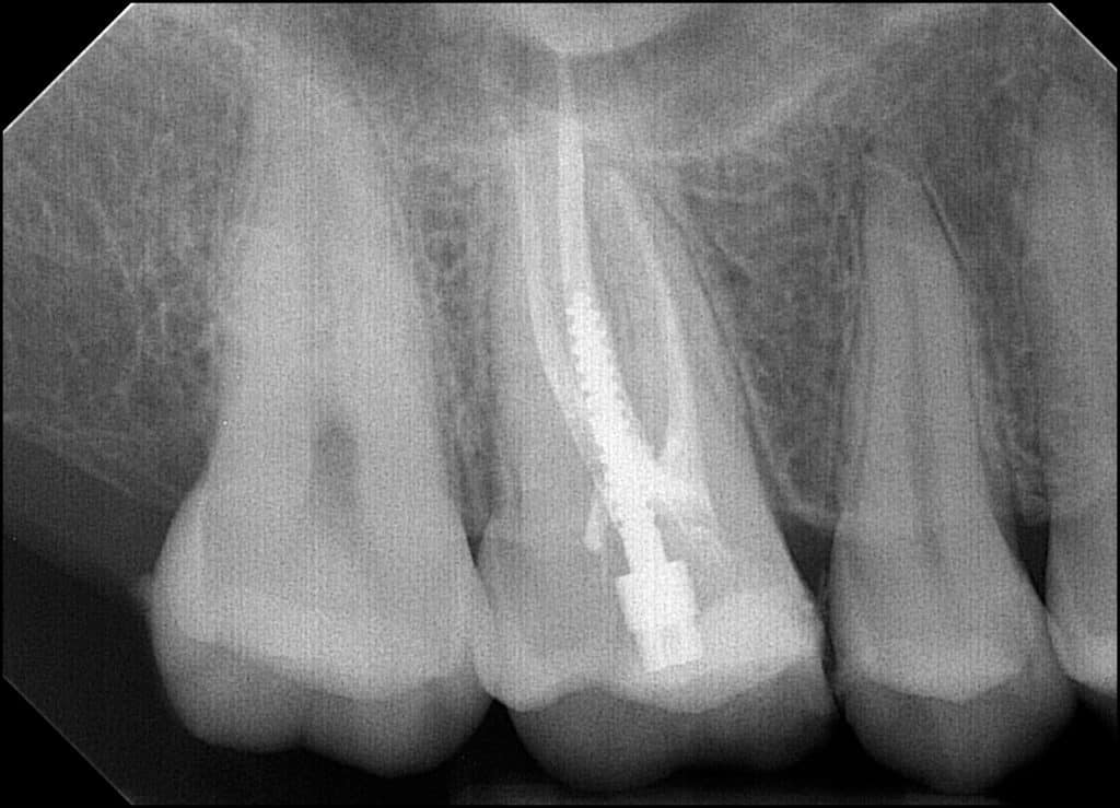Root canal molar tooth