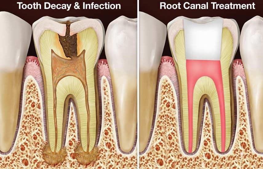 Root-canal-NYC