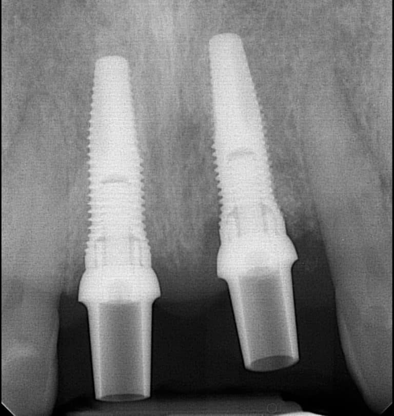 two dental implants x-ray