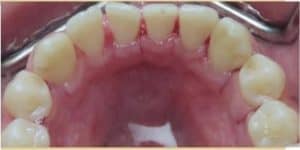 after dental cleaning