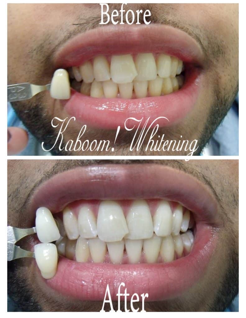 Teeth Whitening before and after photo
