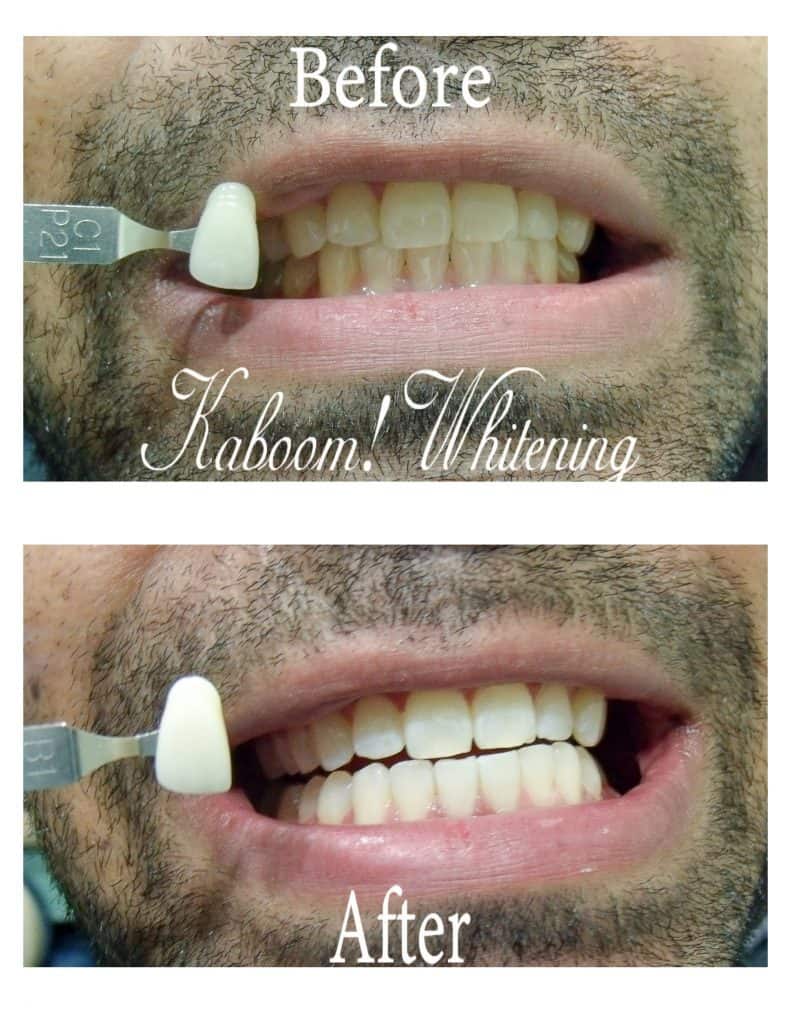 Teeth Whitening before and after image