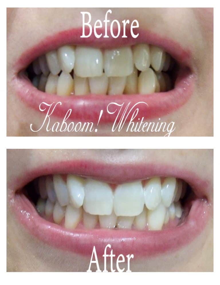 Teeth Whitening before and after photo