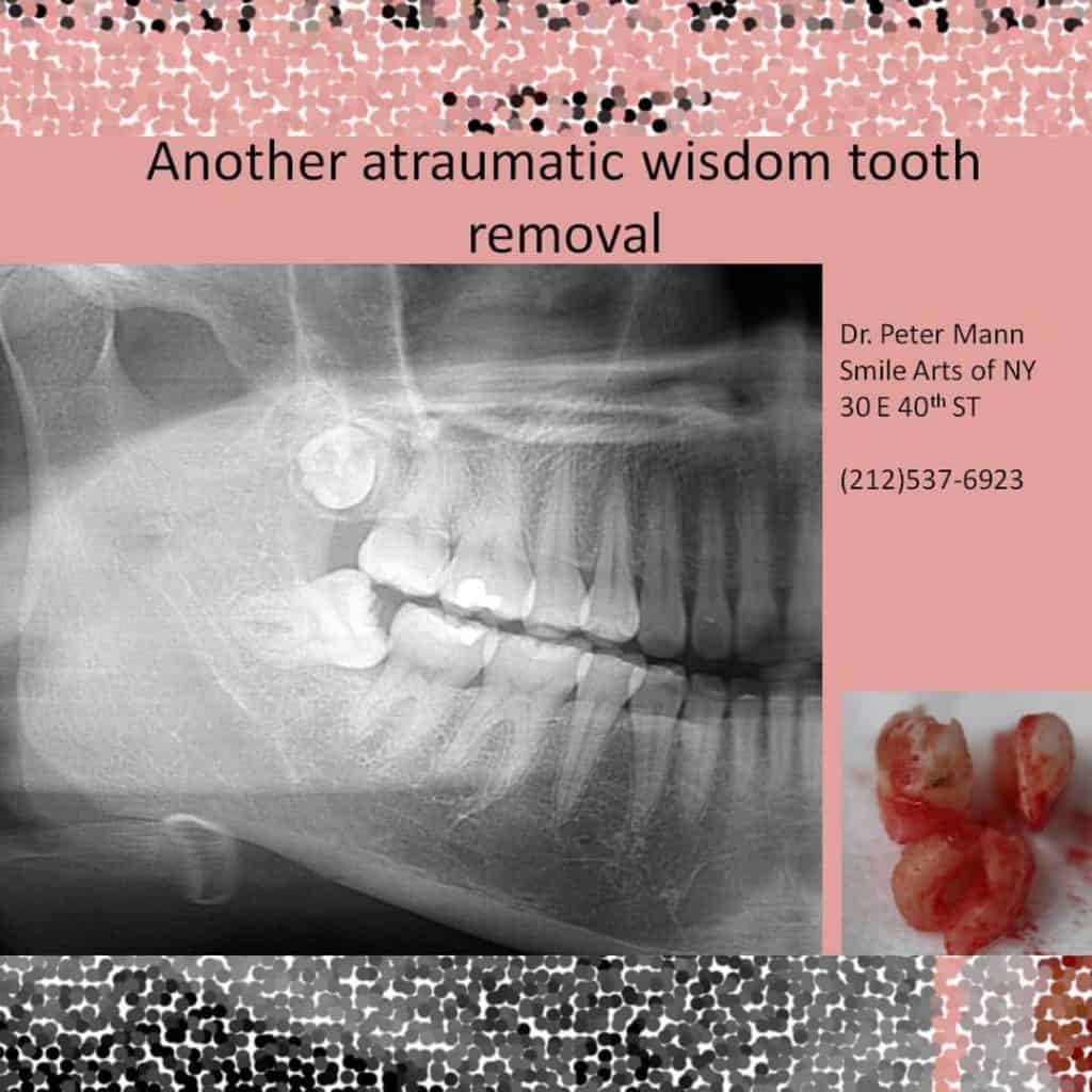 Tooth Extraction NYC | Painless Tooth Extraction | Dentist