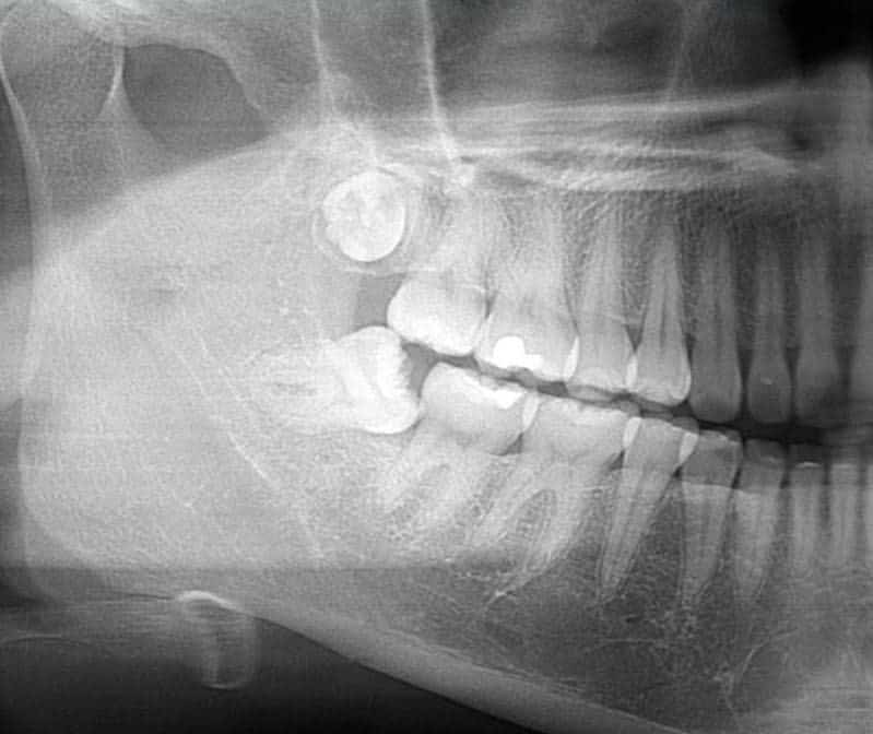 Tooth Extraction NYC | Manhattan Dentist | Painless Extraction