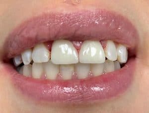 repaired fractured tooth