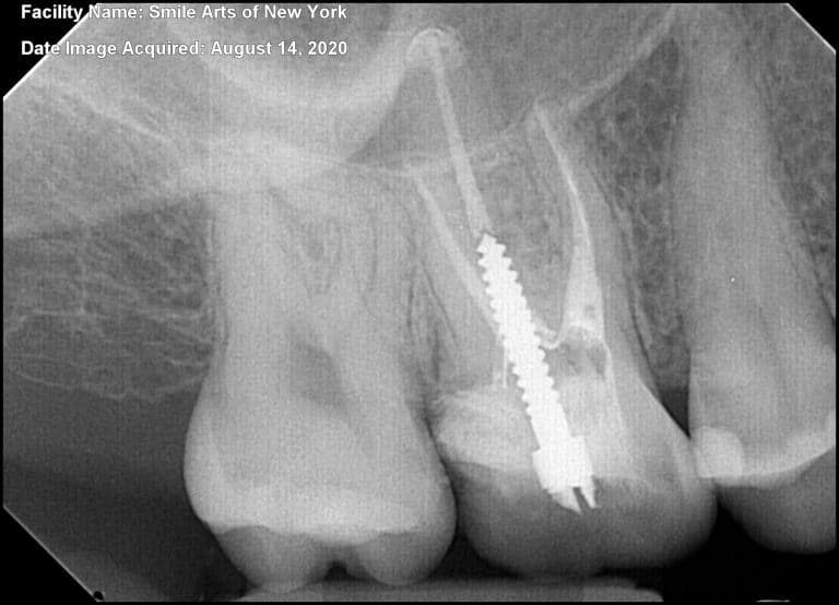 painless molar root canal