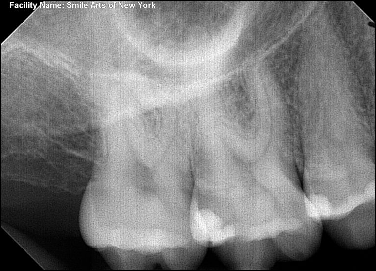 Severe Molar Tooth Decay