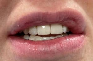 Porcelain crowns