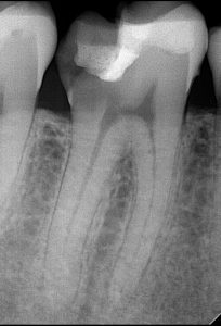 Deep Tooth Cavity