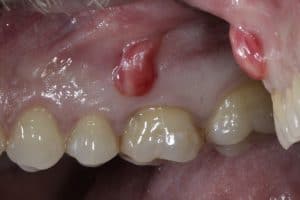 draining fistula