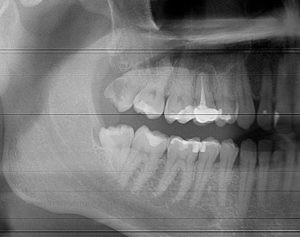 infected wisdom teeth