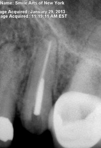 tooth broken at the gum line