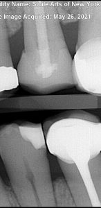 root canal tooth saved