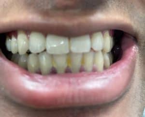 inflamed gums