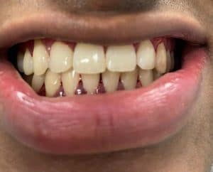 After Dental Cleaning