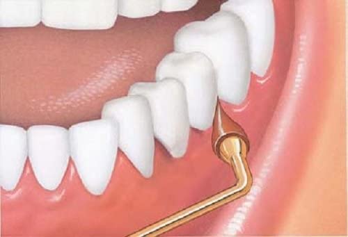 gum stimulator