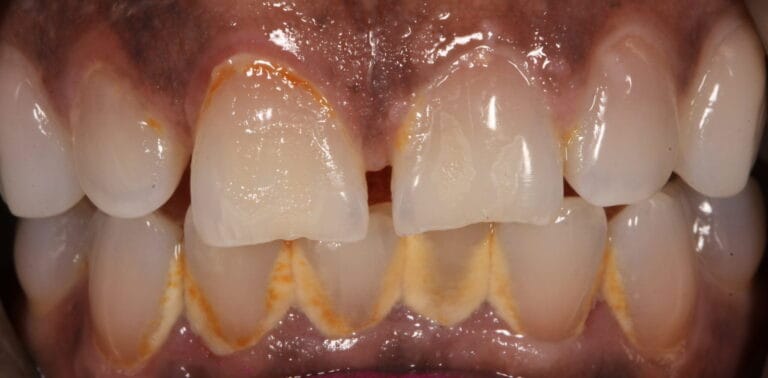 Before Cleaning and Whitening