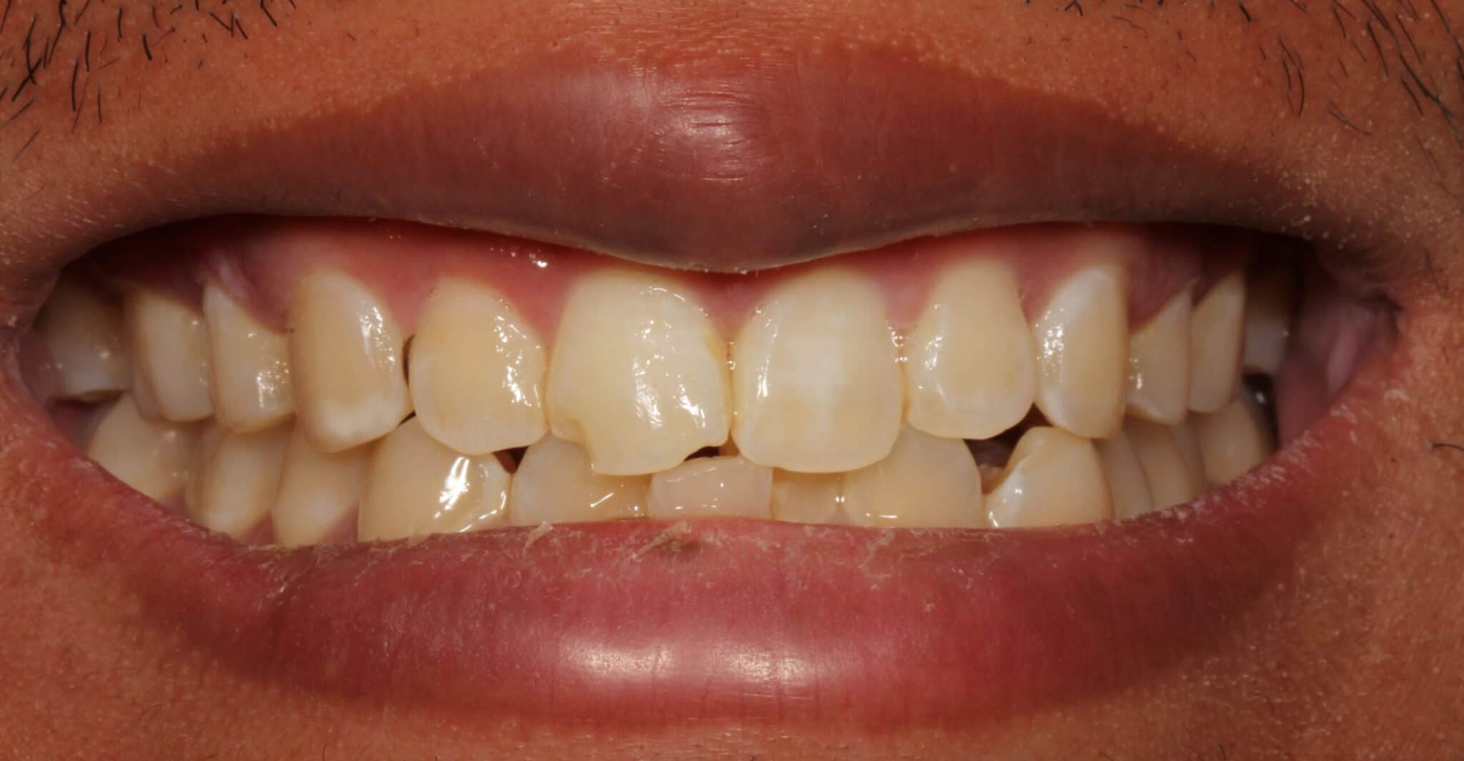 Cosmetic Dentistry Bonding A Broken Front Tooth