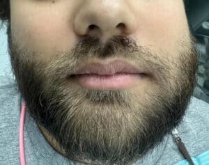 Facial Swelling from infected wisdom tooth