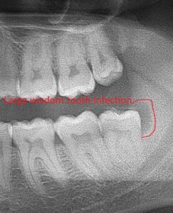 Infected wisdom Tooth